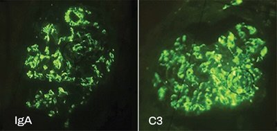 Image showing colocalization of C3 and IgA in a kidney biopsy